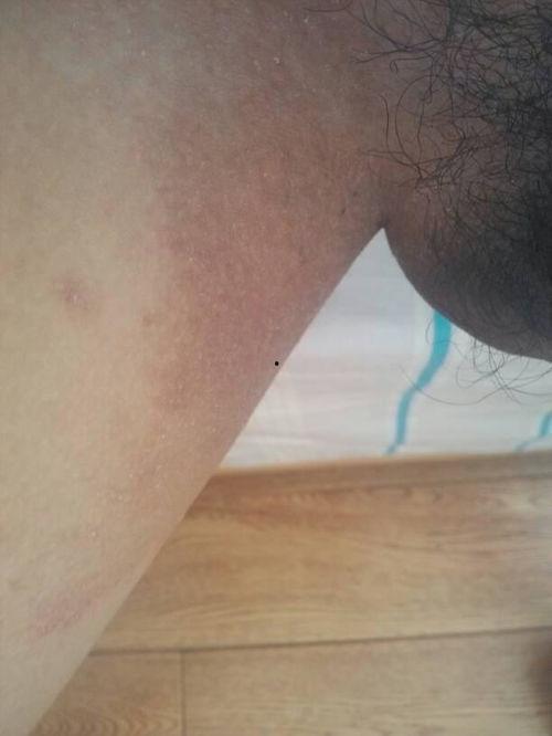 大腿内侧淤青图片,揭秘大腿内侧淤青成因与护理攻略